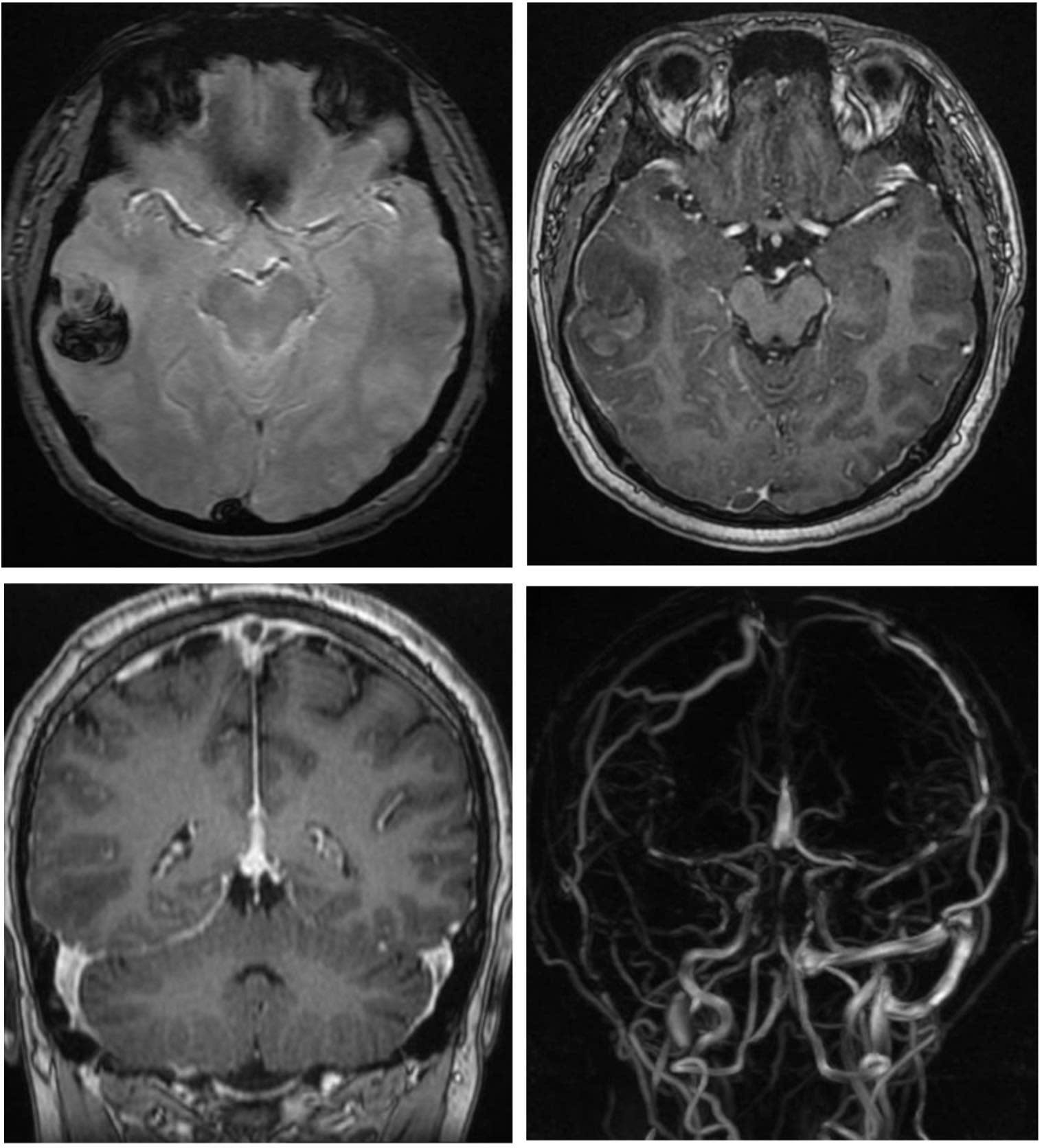 Hút shisha, nam thanh niên 22 tuổi đột quỵ