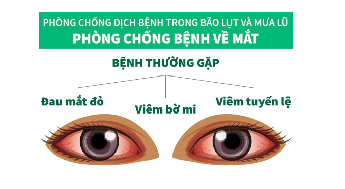 Phòng chống bệnh về mắt mùa bão lụt