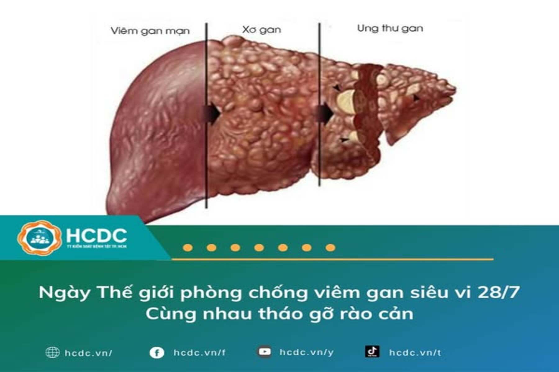 Ngày Thế giới phòng chống viêm gan siêu vi 28/7: Cùng nhau tháo gỡ rào cản