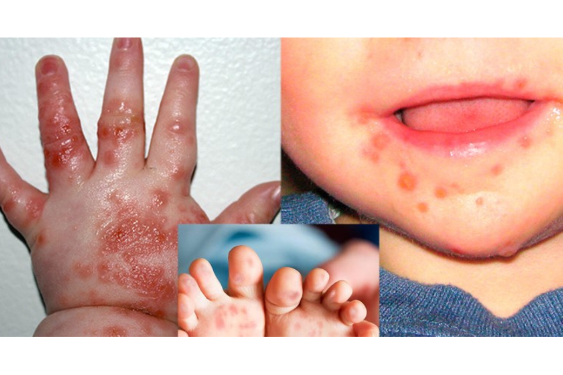 CẢNH BÁO DỊCH TAY CHÂN MIỆNG DO CHỦNG VIRUS EV71: GIA TĂNG CA NẶNG, PHỤ HUYNH KHÔNG NÊN CHỦ QUAN