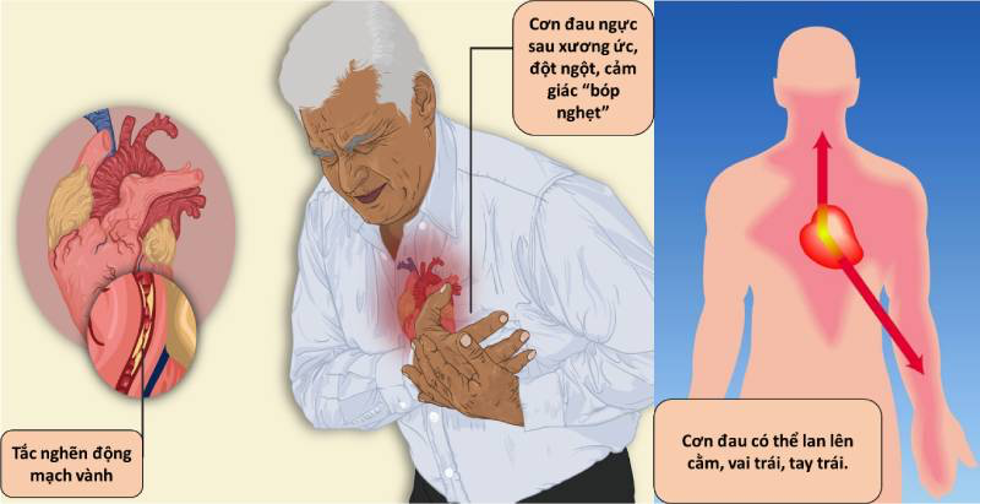 NHỒI MÁU CƠ TIM - BIẾN CHỨNG NGUY HIỂM CỦA TĂNG HUYẾT ÁP