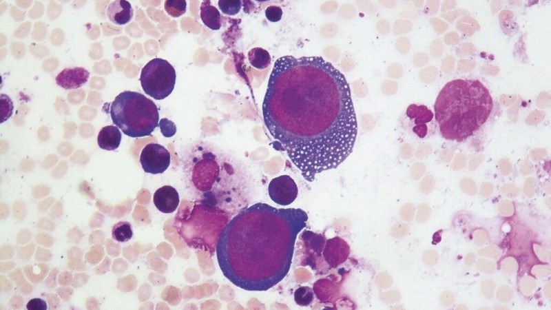 Ghi nhận ca viêm não cấp hiếm gặp do Parvovirus B19 ở Việt Nam