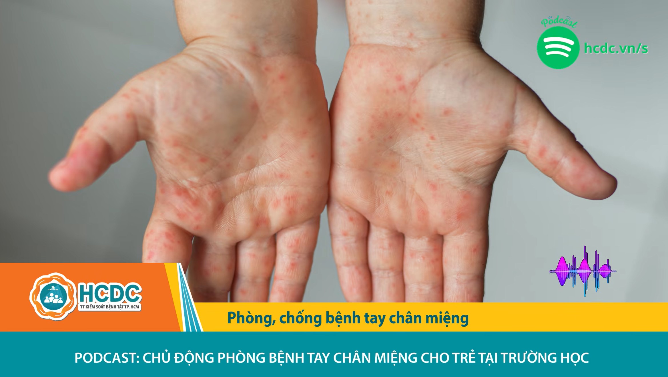 Chủ động phòng bệnh tay chân miệng cho trẻ tại trường học