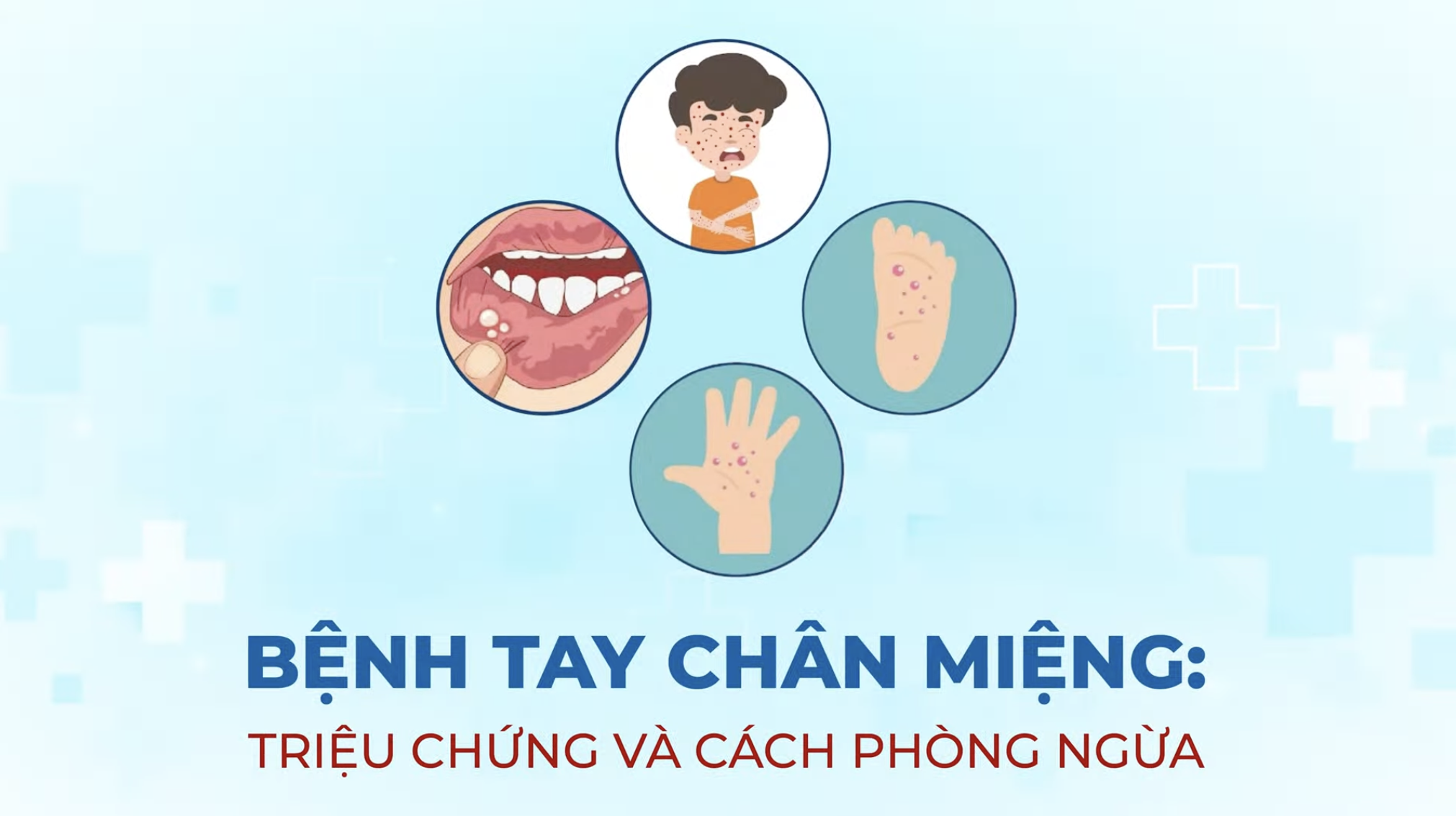 BỆNH TAY CHÂN MIỆNG: TRIỆU CHỨNG VÀ CÁCH PHÒNG NGỪA