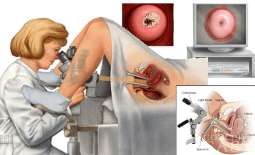 Những điều cần biết về ung thư cổ tử cung