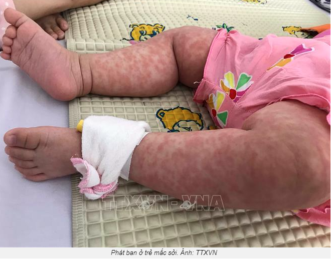 Bệnh sởi đã đến 'mùa', chuyên gia hướng dẫn cách chăm sóc, phòng bệnh