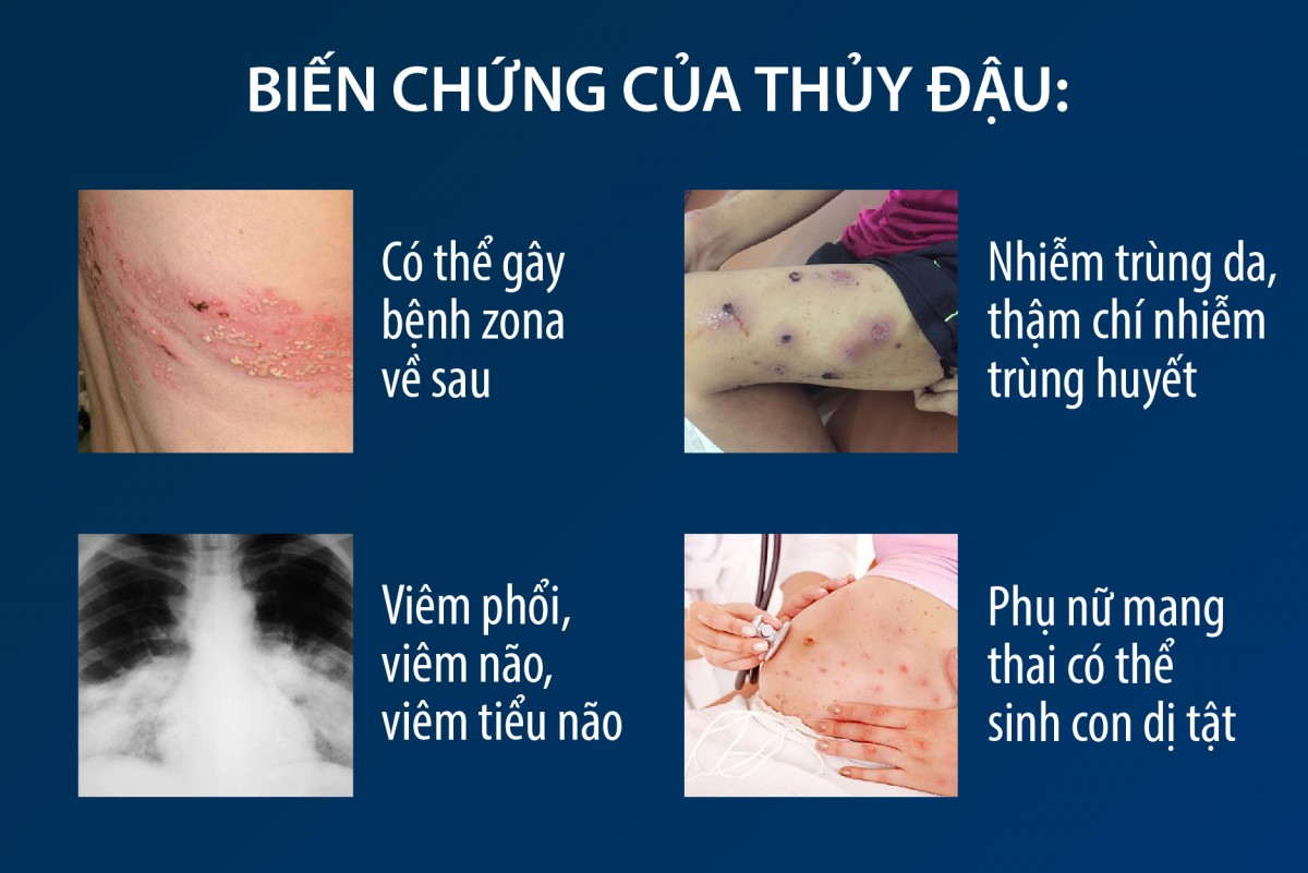 BIẾN CHỨNG CỦA BỆNH THỦY ĐẬU