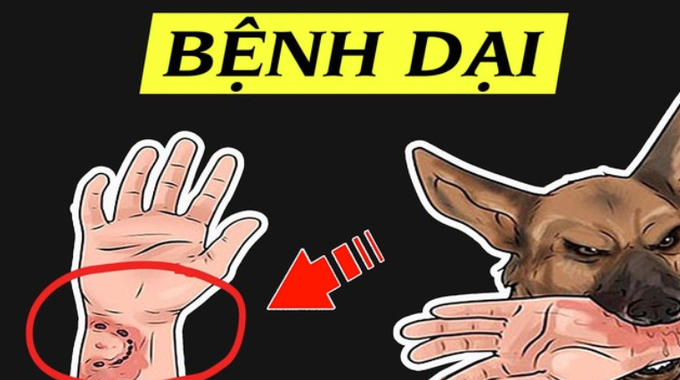 Bệnh dại chỉ có thể phòng bằng tiêm ngừa