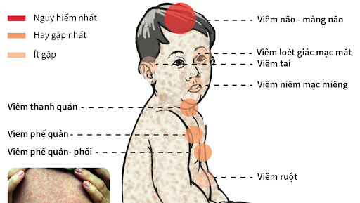 SỐ CA MẮC SỞI TĂNG CAO TRONG 3 THÁNG ĐẦU NĂM 2024