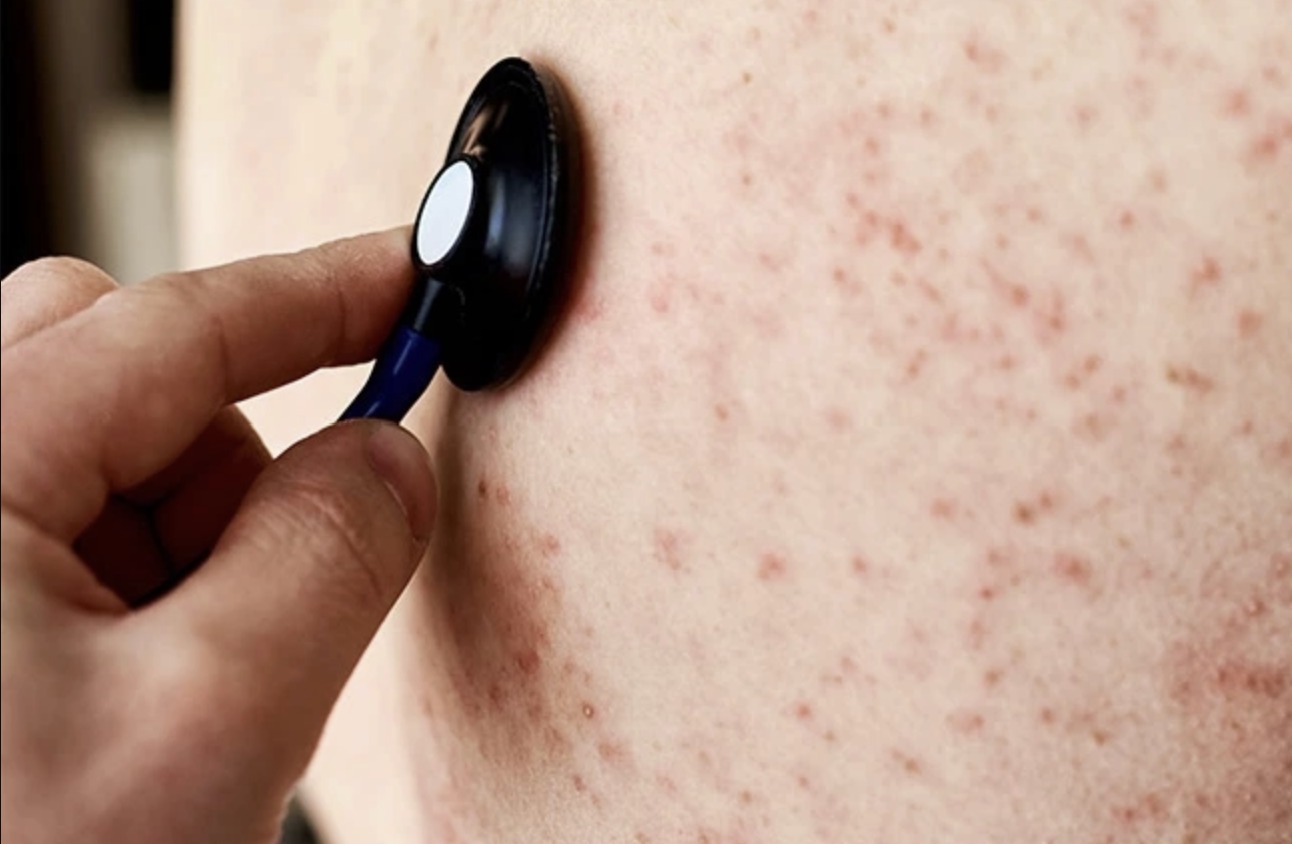 Nhiều trường hợp mắc rubella, dấu hiệu nào nhận biết bệnh sớm?