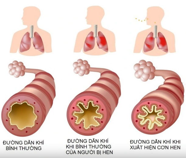 NGÀY HEN PHẾ QUẢN TOÀN CẦU 07/5/2024