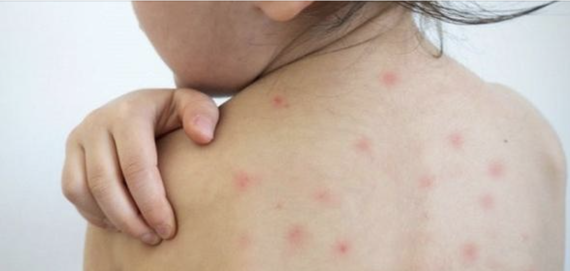 NGUY CƠ CAO BÙNG PHÁT BỆNH SỞI, HO GÀ Ở CÁC TỈNH PHÍA NAM